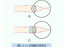 近视眼及其矫正