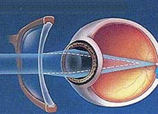 矫正的近视眼